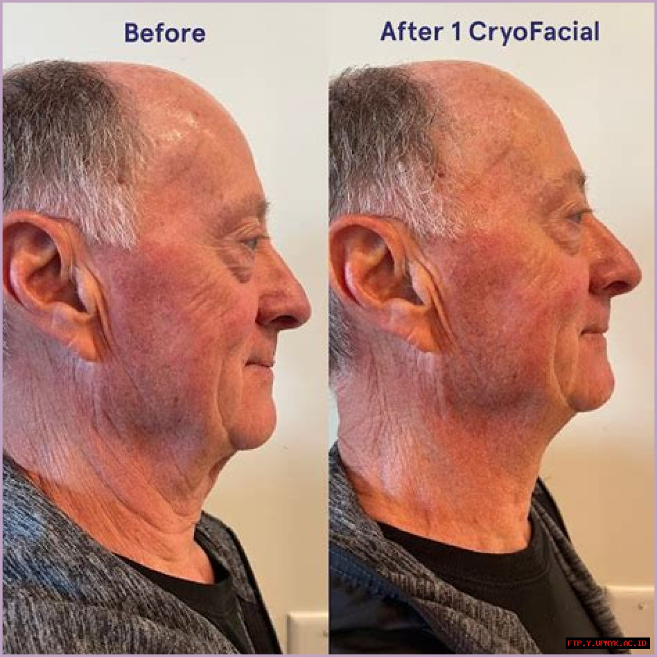 Before And After Cryotherapy Pictures: See The Transformation