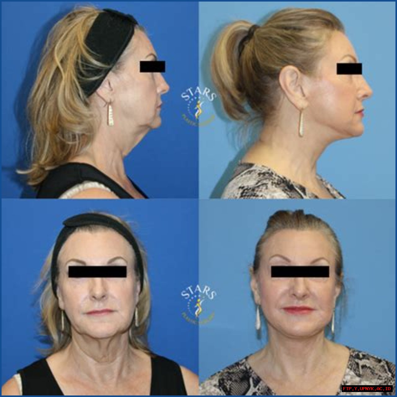 Botched Neck Lift: Avoidable Mistakes And Precautionary Measures