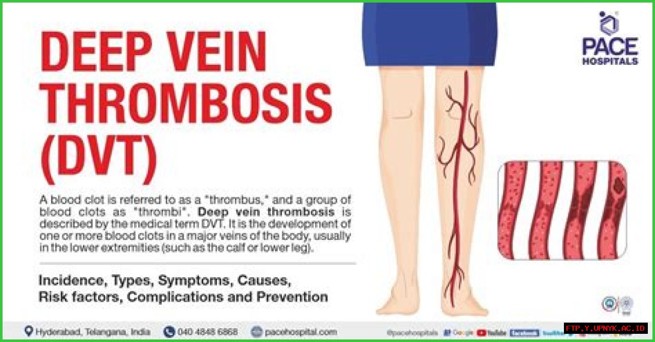Guide To ICD-10 Codes For Deep Vein Thrombosis Of The Lower Extremity