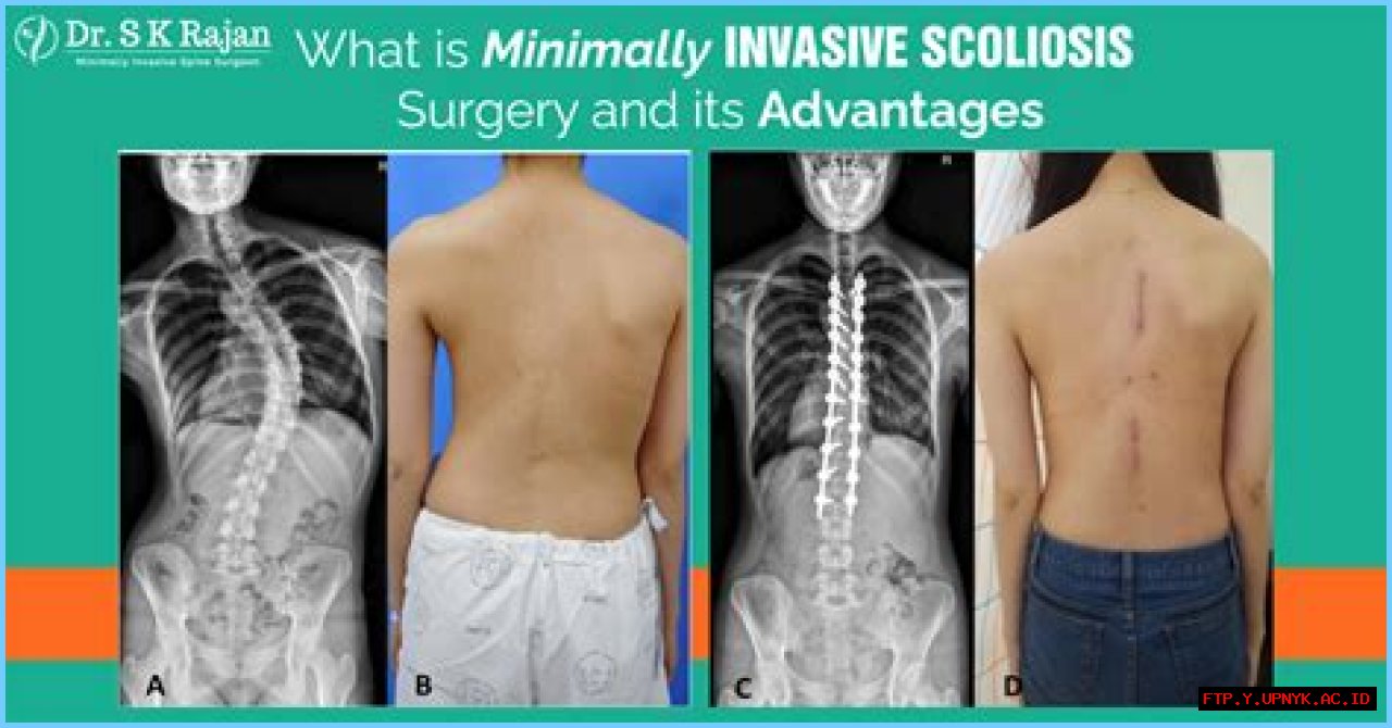 Guide To Scoliosis Scar Removal And Treatment