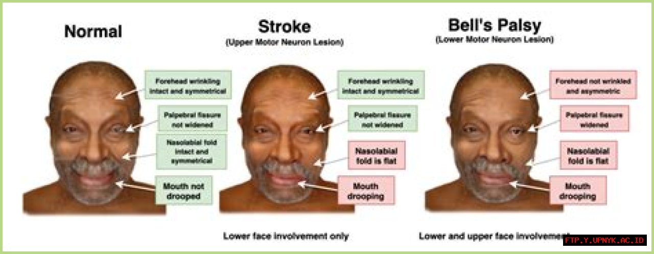 Has Rob Lowe Been Affected By A Stroke?