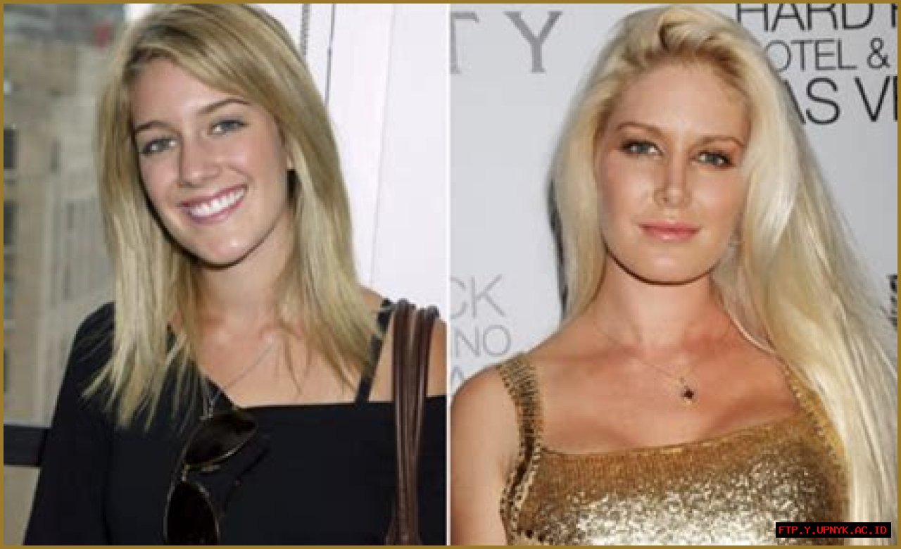 Heidi Montag's Stunning Transformation: Before And After Surgery