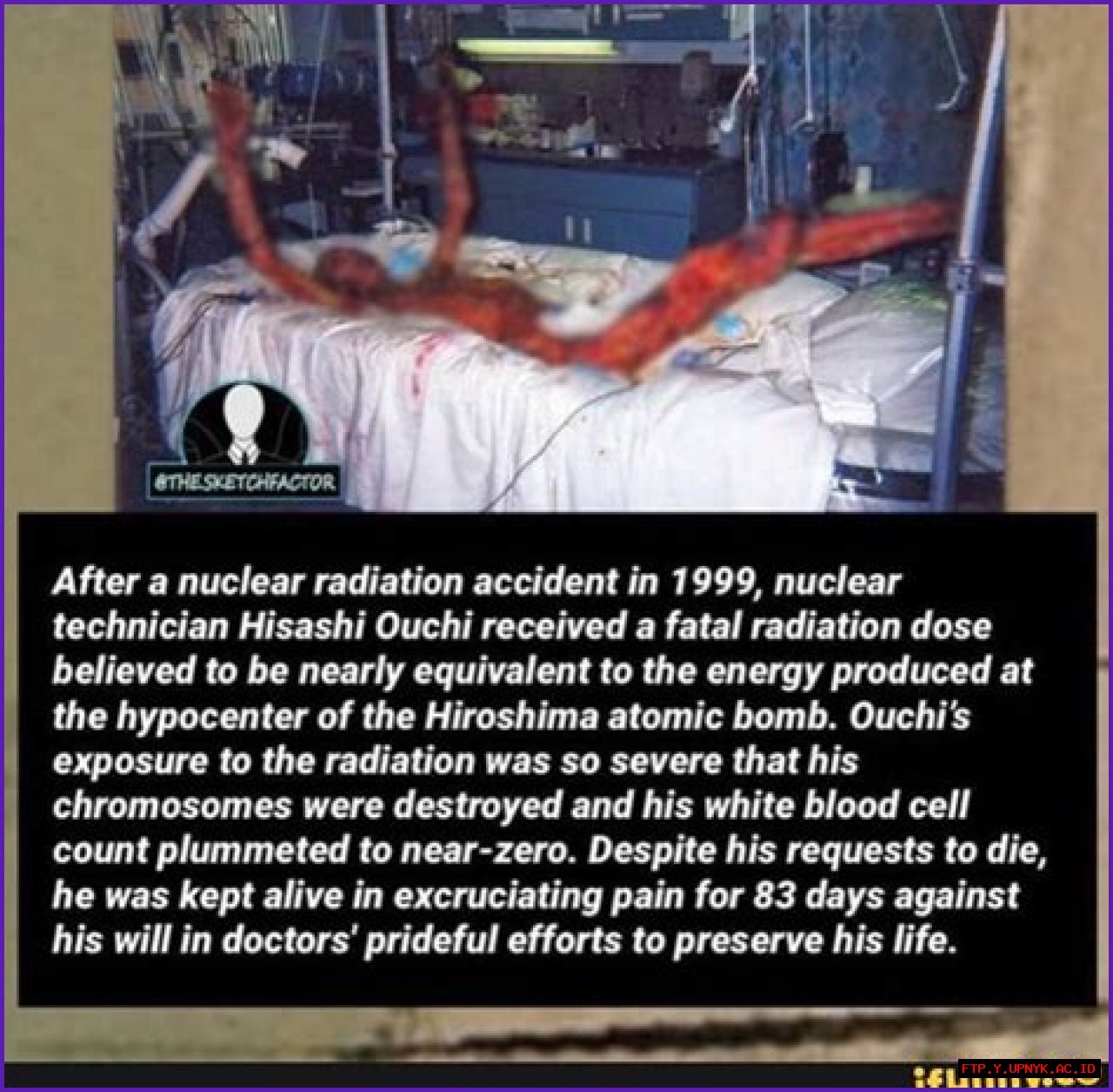 Hisashi Ouchi: A Tragic Tale Of Nuclear Radiation's Devastating Effects