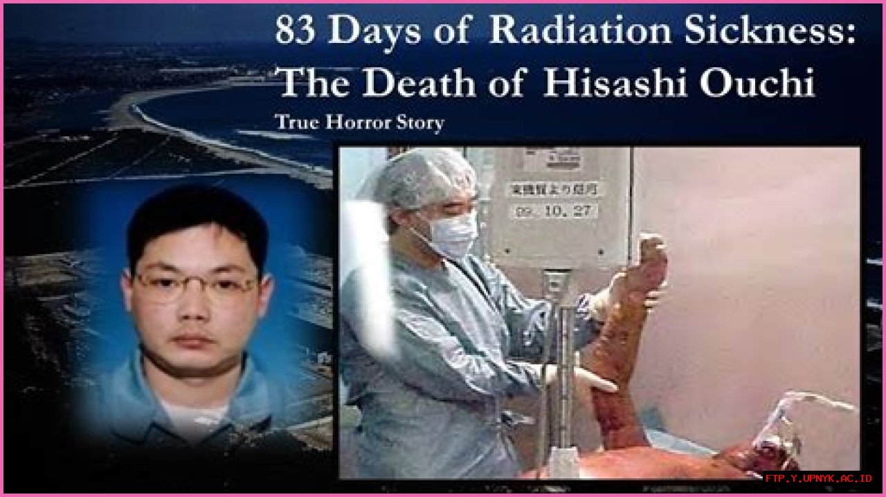 Hisashi Ouchi's Skin: A Tragic Tale Of Radiation Exposure