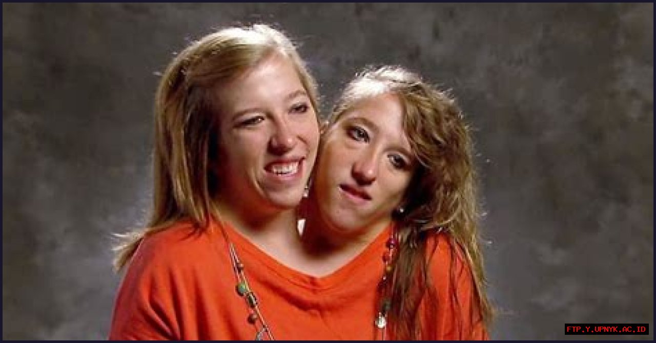 Incredible Anatomy Of Conjoined Twins Abby And Brittany Hensel