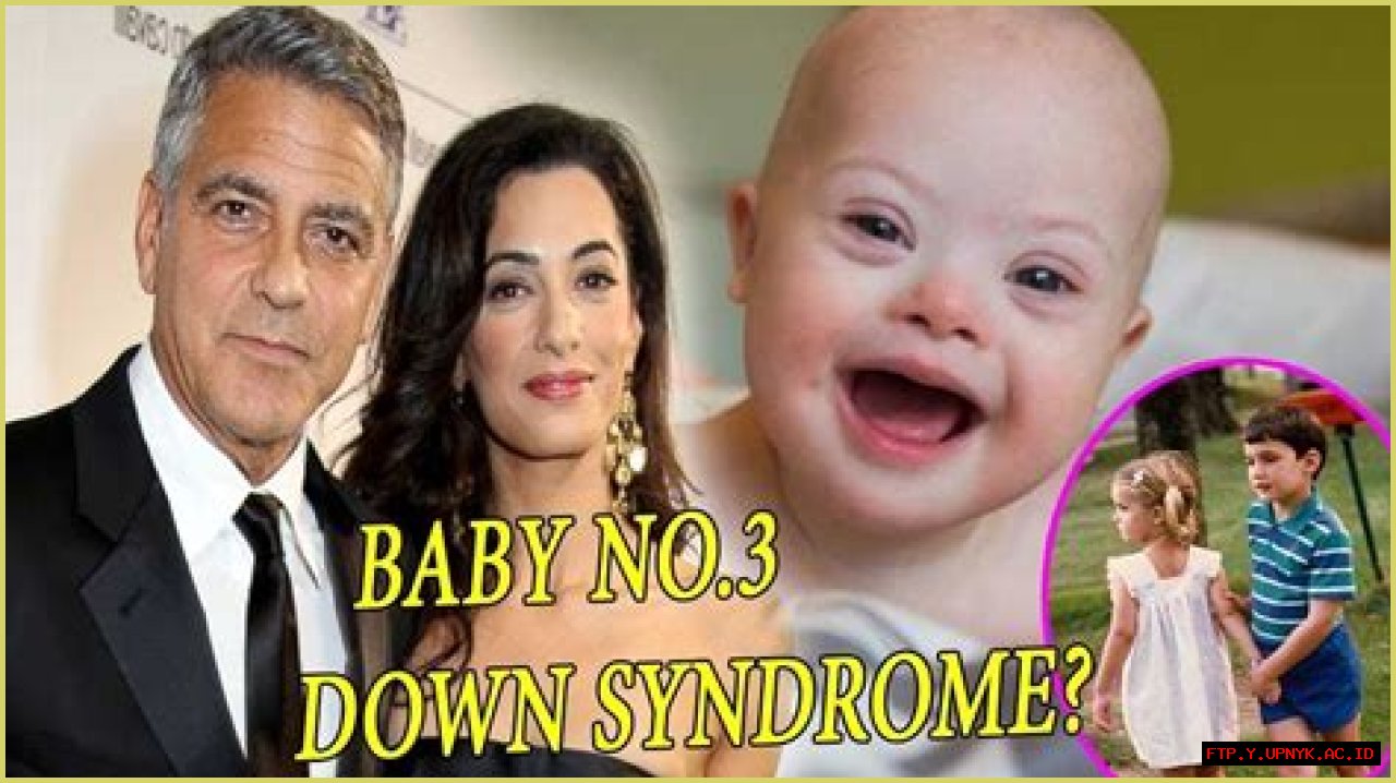 Is George Clooney's Son Affected By Down Syndrome?
