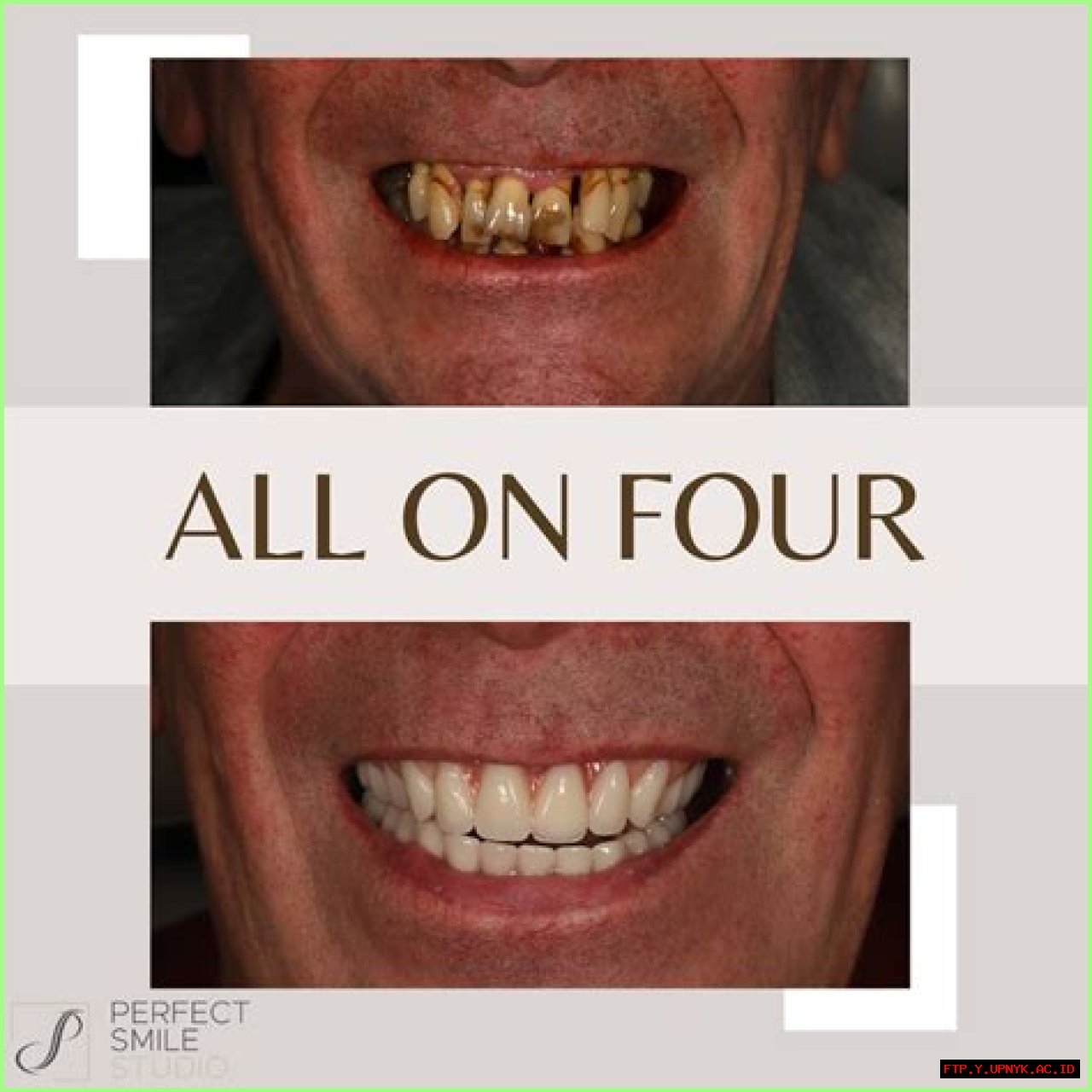 Latest Developments In All-on-4 Lawsuits