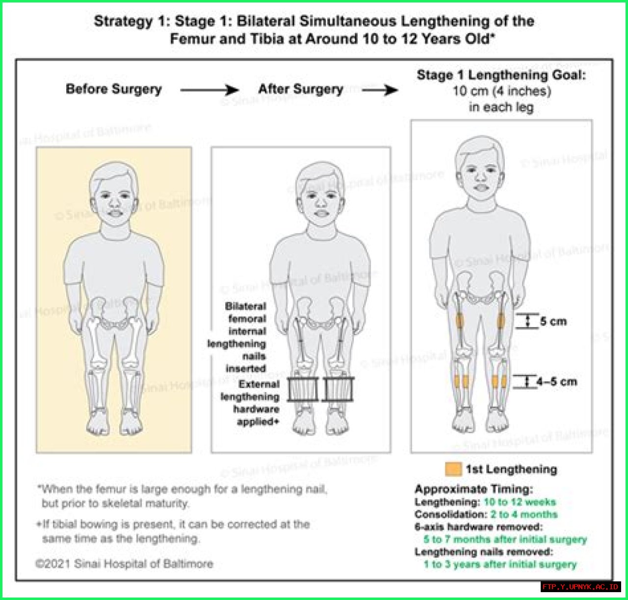 Leighton's Stature: Unraveling The Truth About Dwarfism