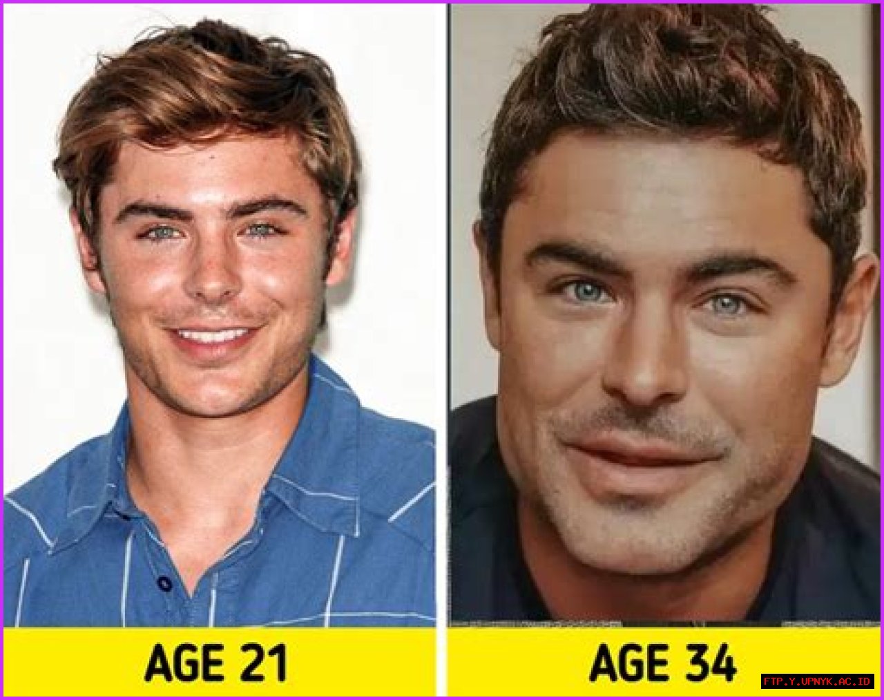 Plastic Surgeon Reveals The Truth Behind Zac Efron's Facial Transformation