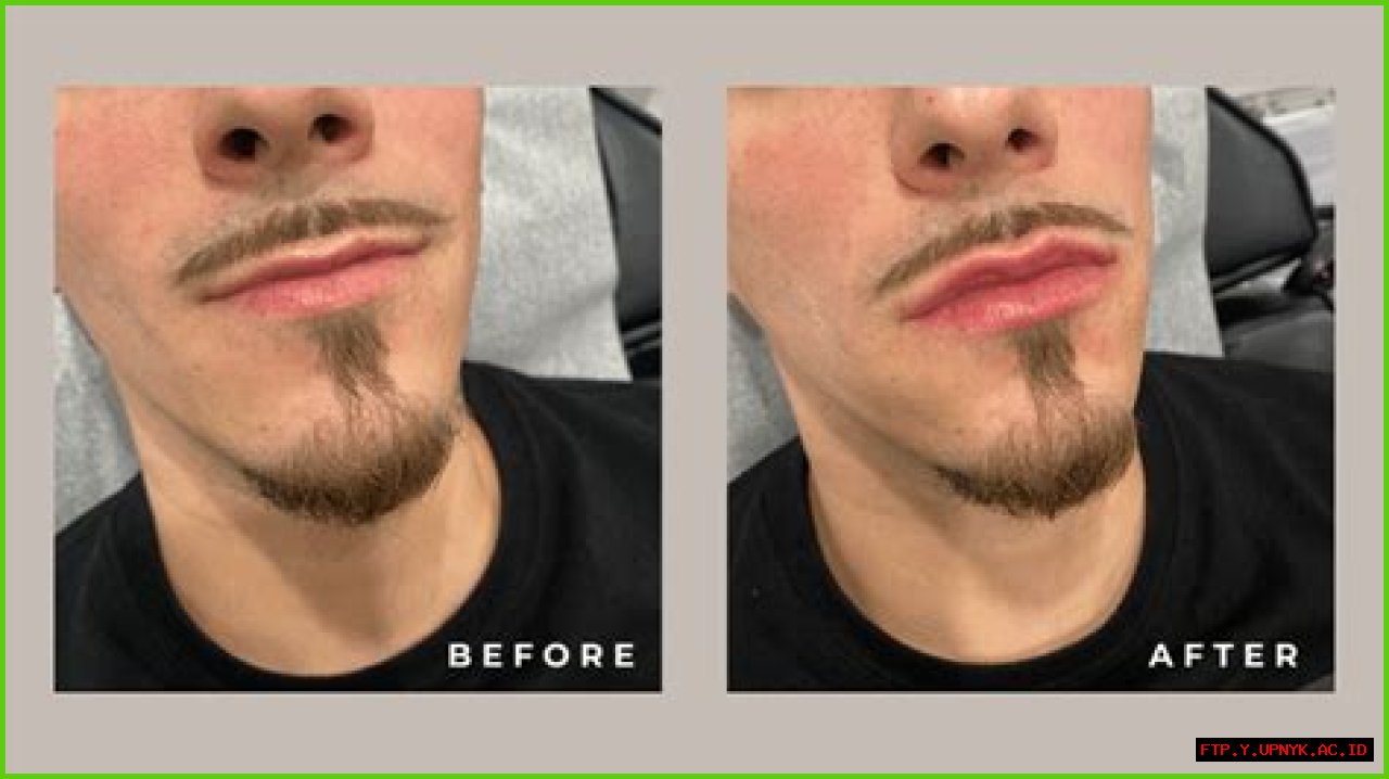 Remarkable Lip Enhancement: Explore Men's Lip Fillers Before And After