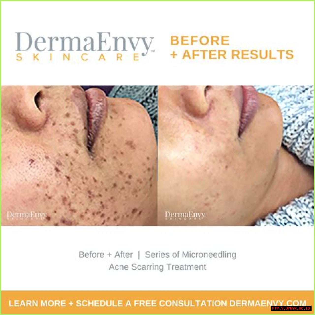 Revolutionary Salmon DNA Microneedling: Unlocking Youthful Radiance