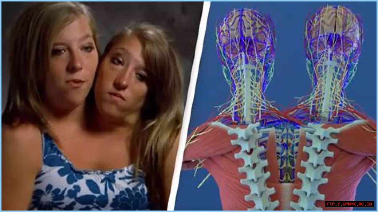 The Extraordinary Anatomy Of Abby And Brittany Hensel: A Biomedical Exploration