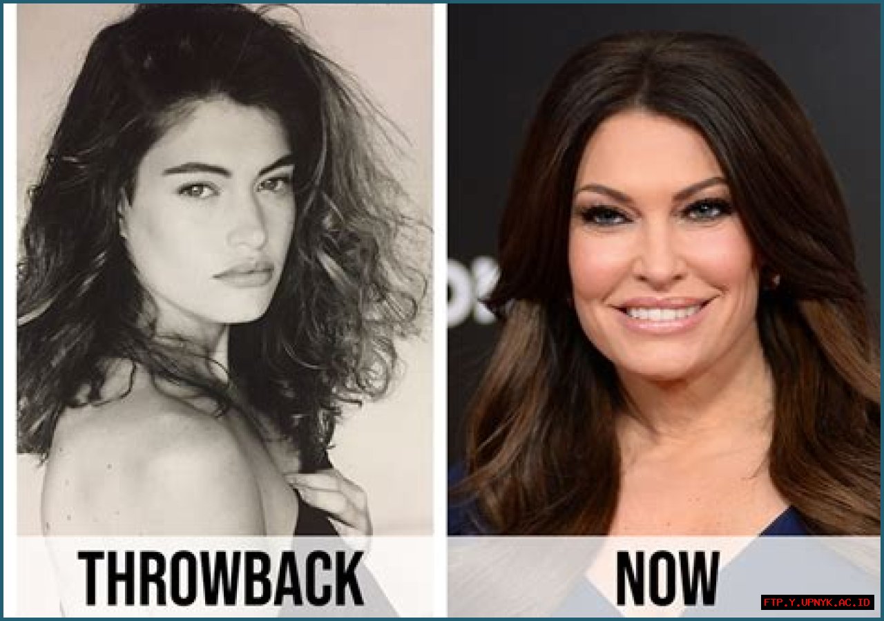 Transformation And Controversy: Kimberly Guilfoyle After Plastic Surgery