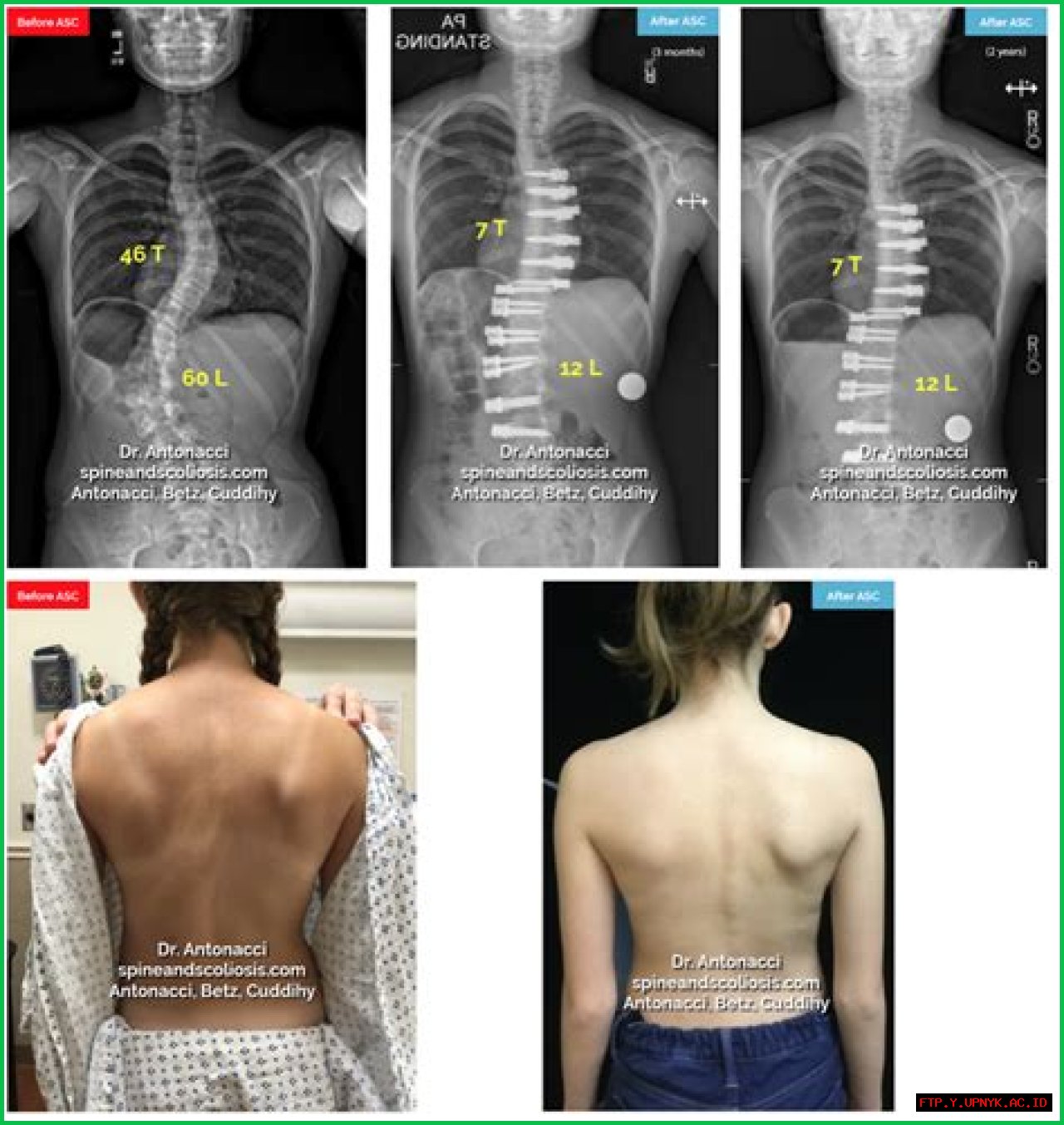 Ultimate Guide To Scar Scoliosis Surgery: Healing And Recovery