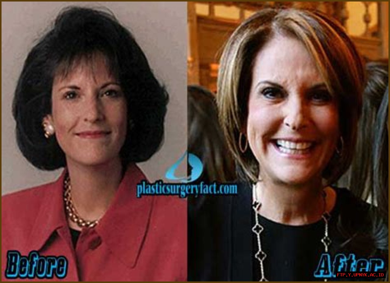 Ultimate Guide: Unveiling Gloria Borger's Plastic Surgery Journey