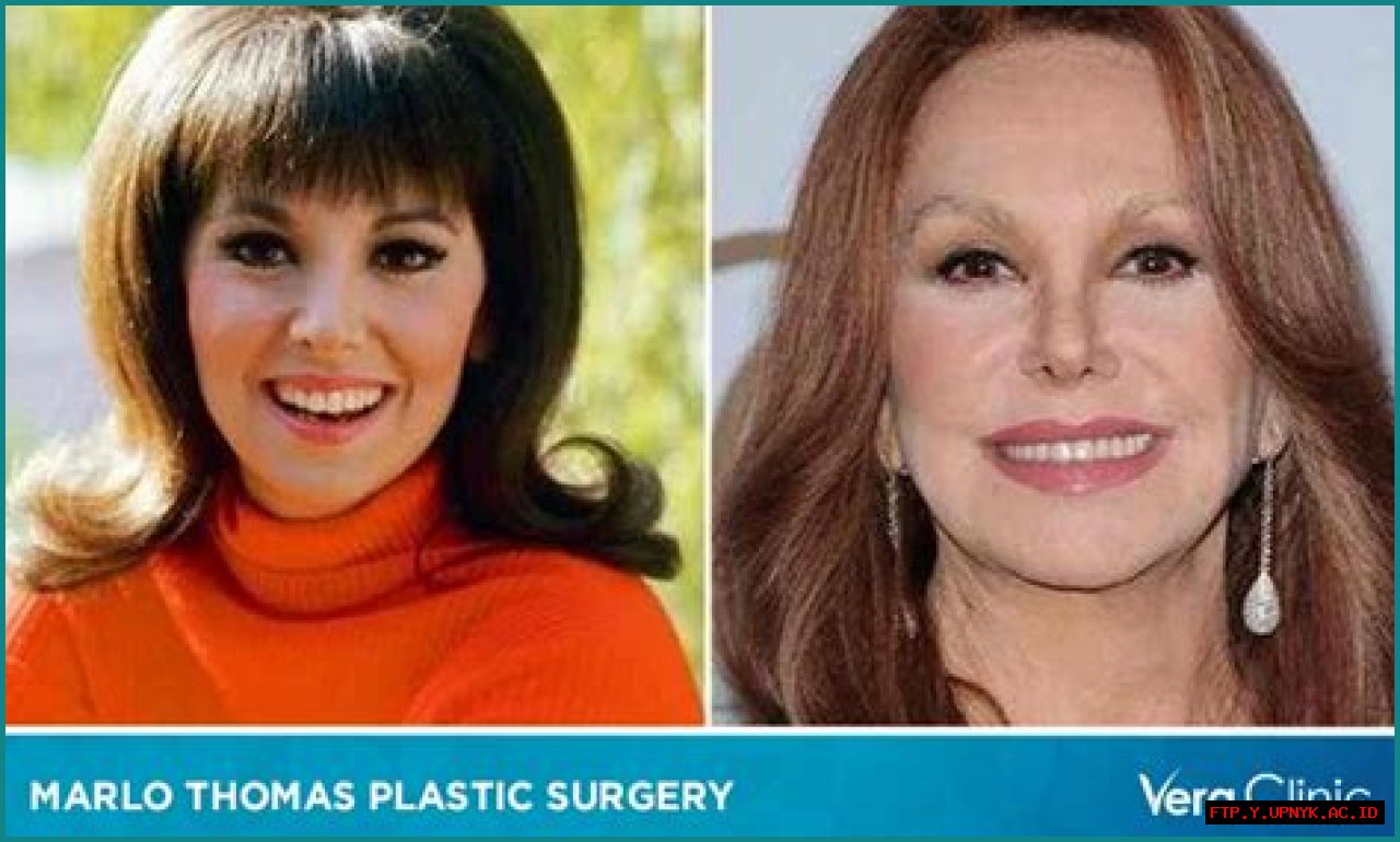Uncovering Marlo Thomas's Surgeries: A Comprehensive Guide