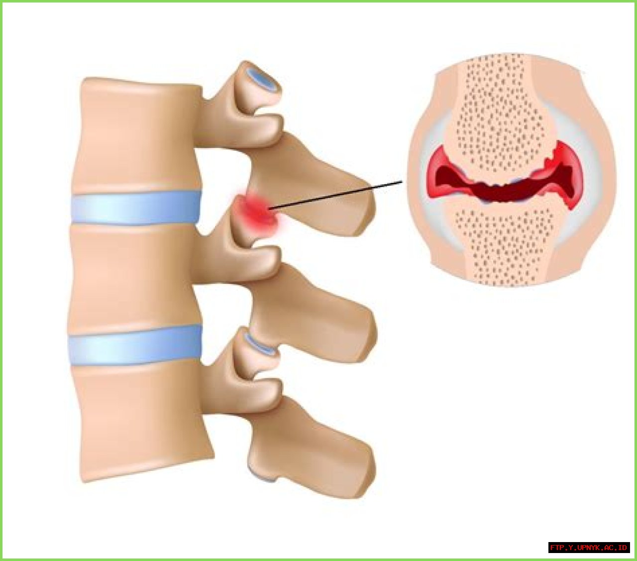 Understanding Hypertrophic Facet Arthropathy: Causes, Symptoms, And Treatment