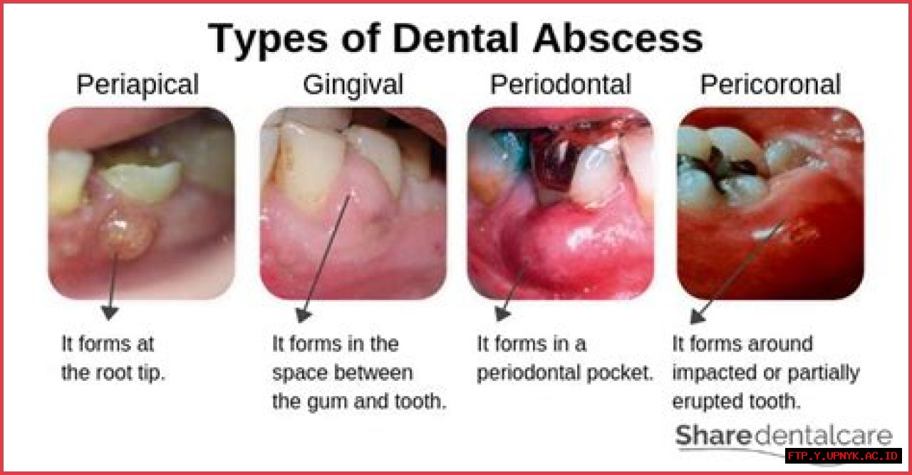 Understanding The Difference Between Gum Abscess And Tooth Abscess