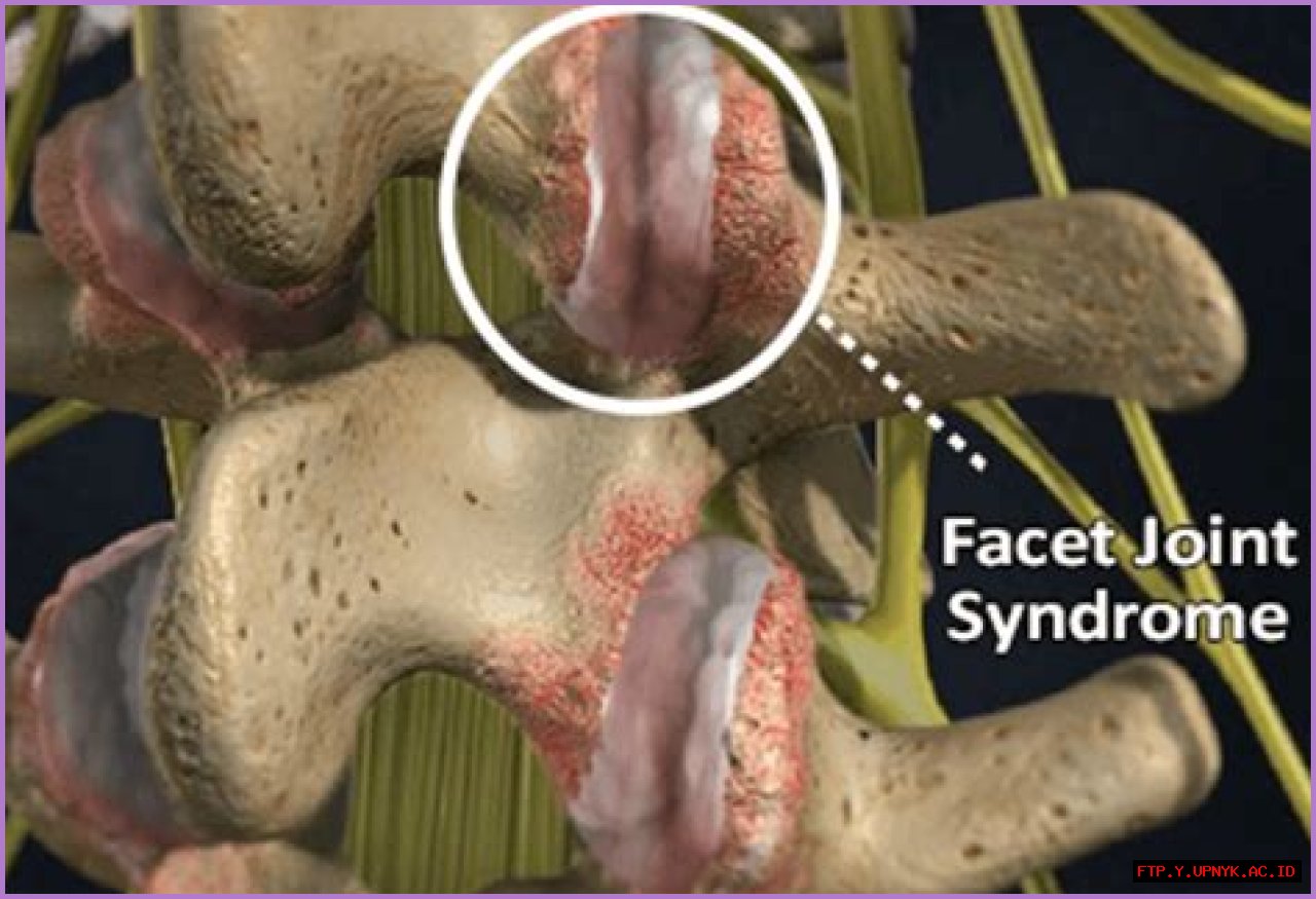 Unlocking The Secrets Of Severe Facet Hypertrophy: Causes, Symptoms, And Treatment