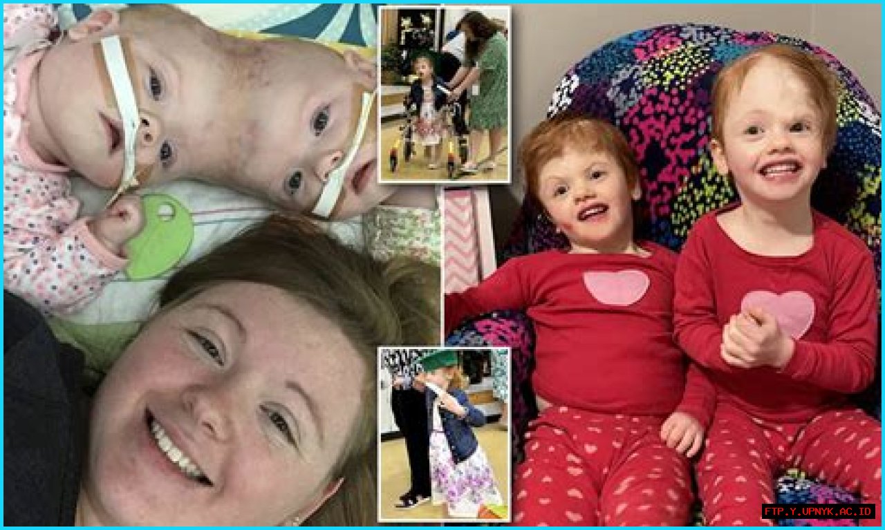 Unraveling The Enigma Of Dicephalus Conjoined Twins: An Exploration Of The Extraordinary And Perplexing