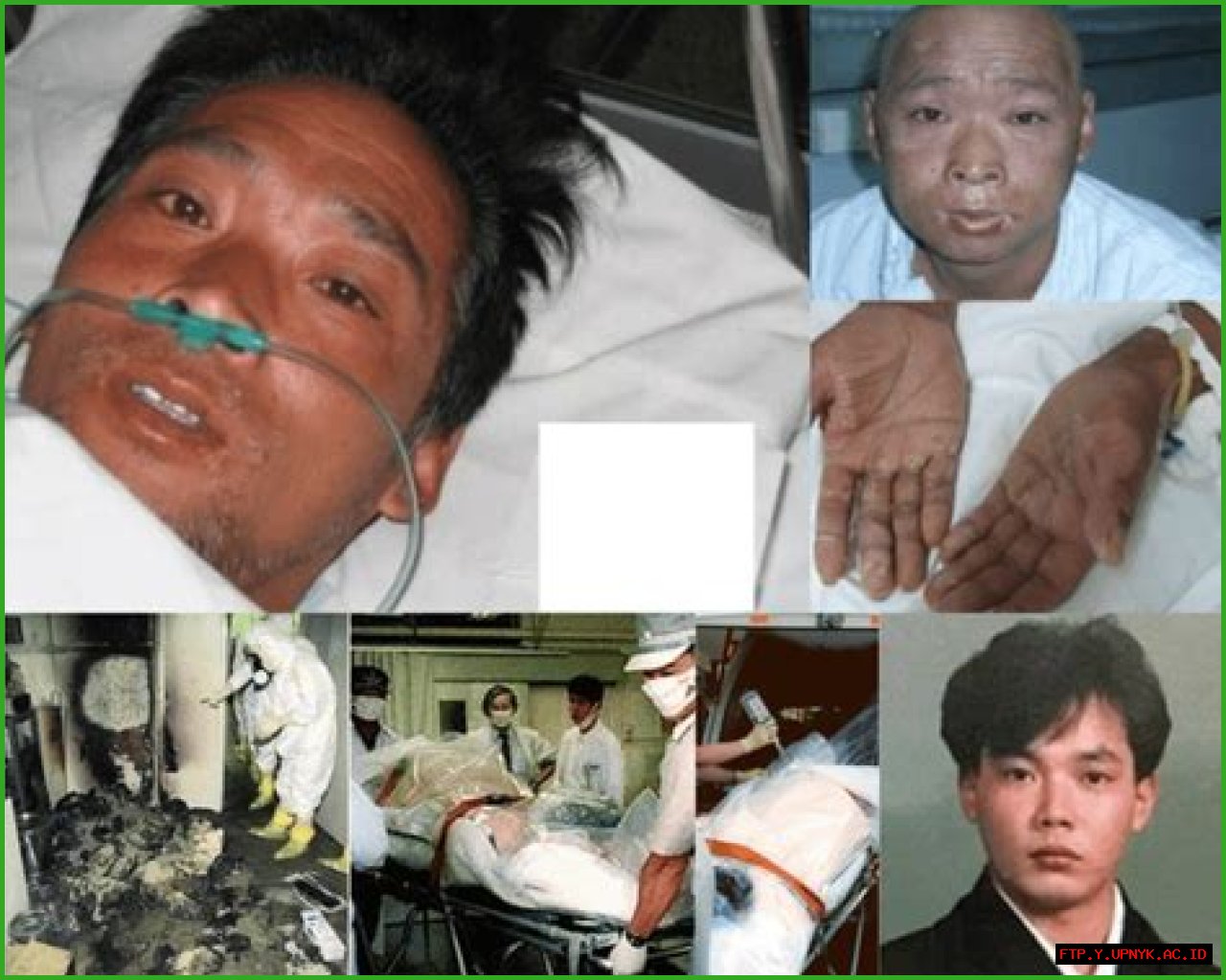 Unveiling The Tragic Reality: Hisashi Ouchi After Radiation Photos