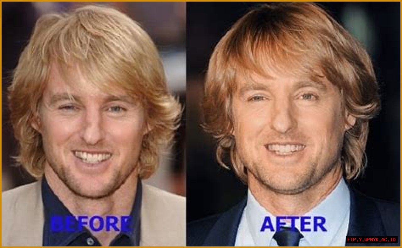 Unveiling The Transformation: Owen Wilson Before Nose Surgery
