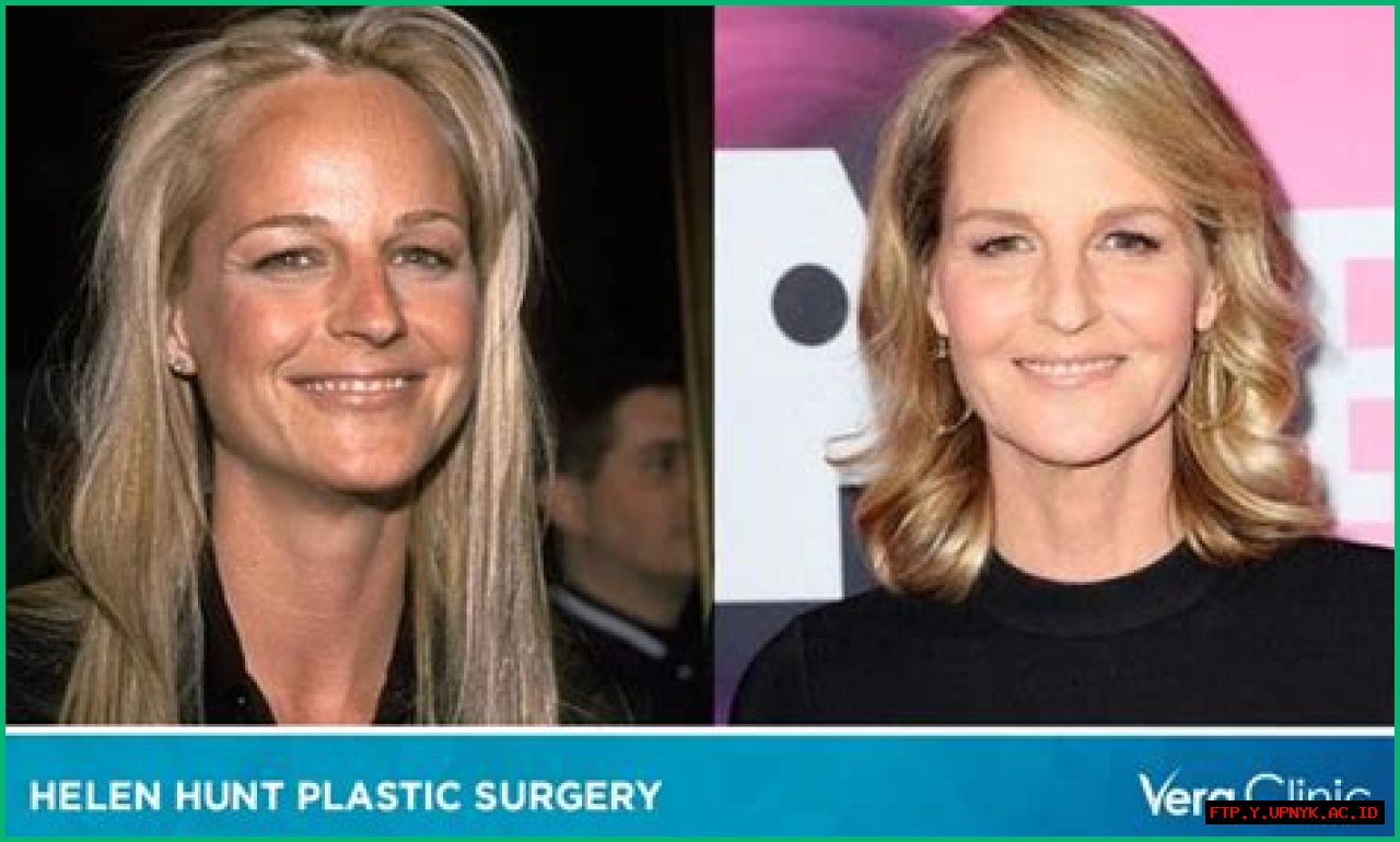 Unveiling The Truth: Helen Hunt And Her Journey With Plastic Surgery